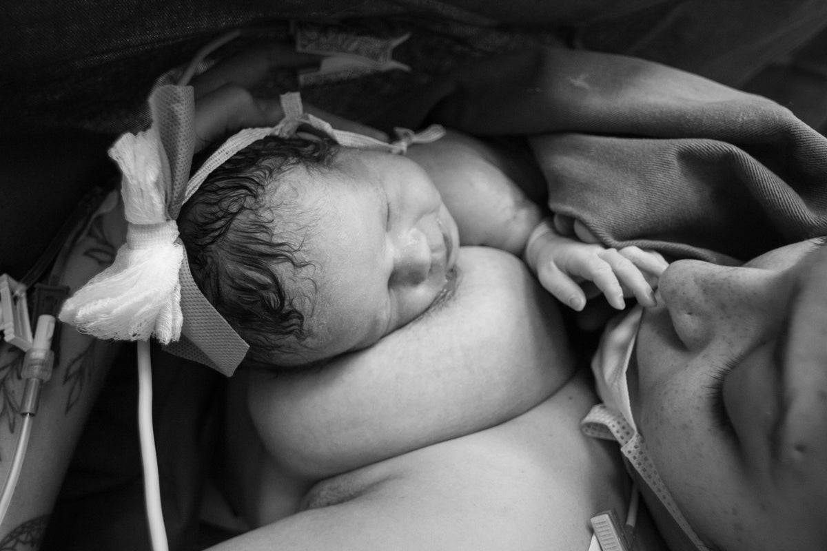 c-section scar photos, c-section healing photos