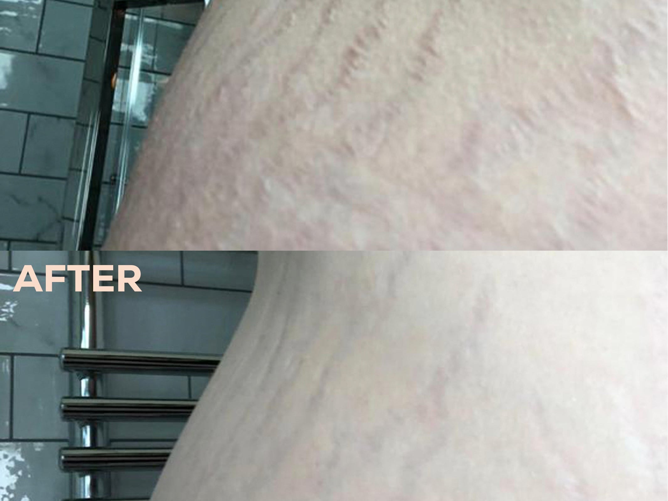 Before and after comparison of skin texture on a curved body area, showing visible stretch marks in the top 'BEFORE' panel and reduced marks in the bottom 'AFTER' panel, with a tiled wall and towel rack in the background.
