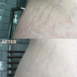 Before and after comparison of skin texture on a curved body area, showing visible stretch marks in the top 'BEFORE' panel and reduced marks in the bottom 'AFTER' panel, with a tiled wall and towel rack in the background.