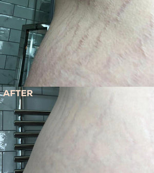 Before and after comparison of skin texture on a curved body area, showing visible stretch marks in the top 'BEFORE' panel and reduced marks in the bottom 'AFTER' panel, with a tiled wall and towel rack in the background.